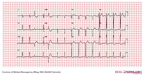 ventricular hypertrophy ecg